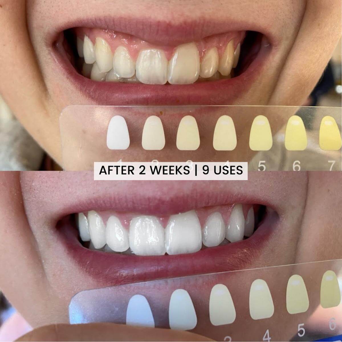 Teeth Whitening Before & After Result