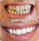 Teeth Whitening Before & After Result